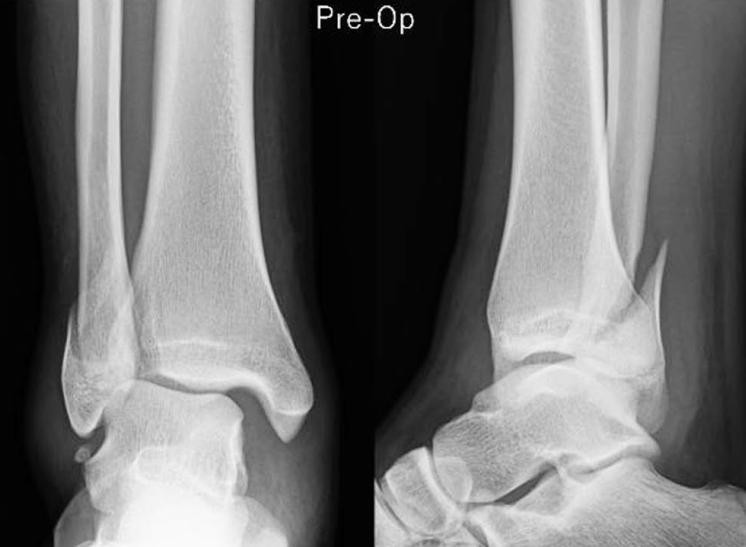 “骑缝钉”辅助固定骨折：锦上添花还是画蛇添足？