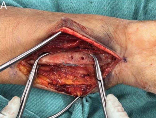 “骑缝钉”辅助固定骨折：锦上添花还是画蛇添足？