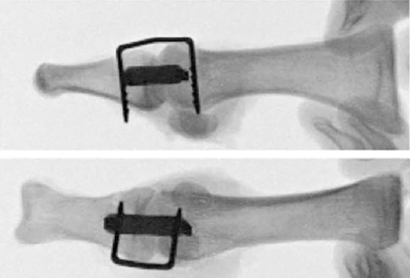 “骑缝钉”辅助固定骨折：锦上添花还是画蛇添足？