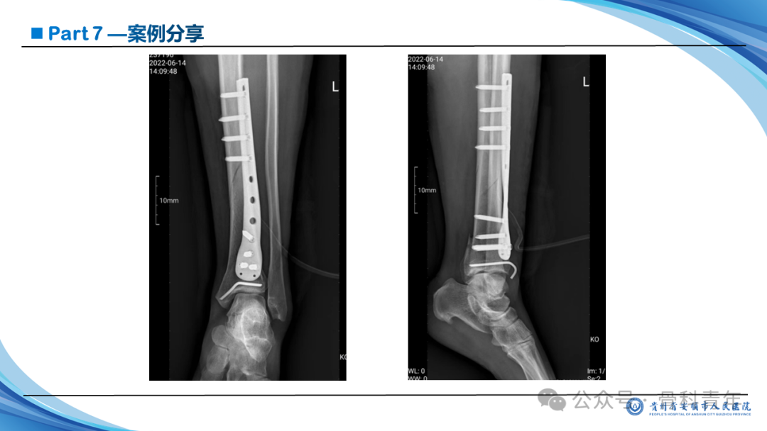 张-侯氏（Z-H）骨折的损伤机制、诊断与治疗