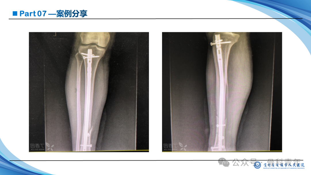 张-侯氏（Z-H）骨折的损伤机制、诊断与治疗