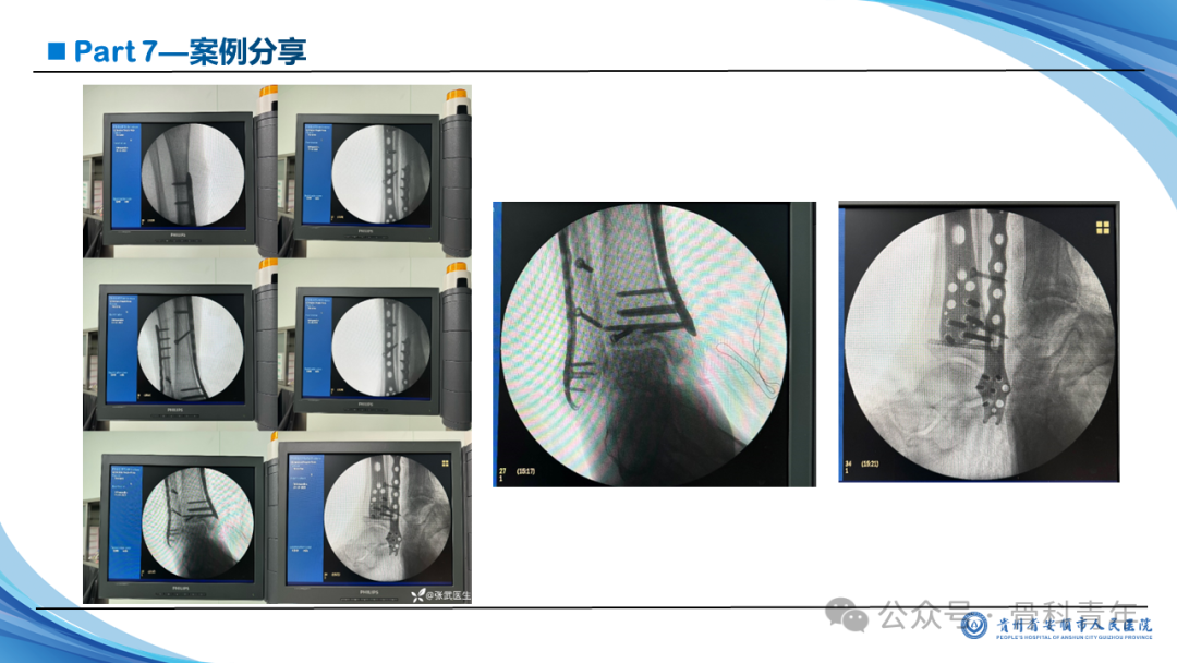 张-侯氏（Z-H）骨折的损伤机制、诊断与治疗