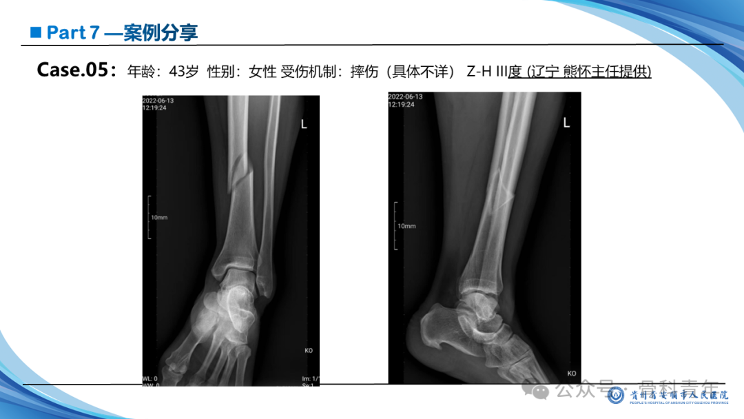 张-侯氏（Z-H）骨折的损伤机制、诊断与治疗