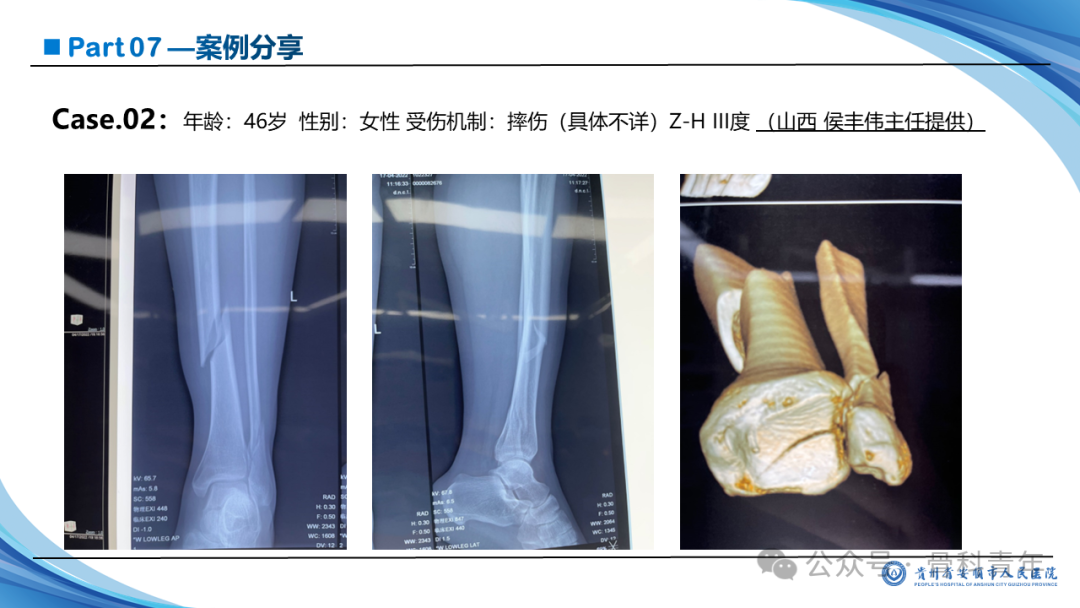 张-侯氏（Z-H）骨折的损伤机制、诊断与治疗