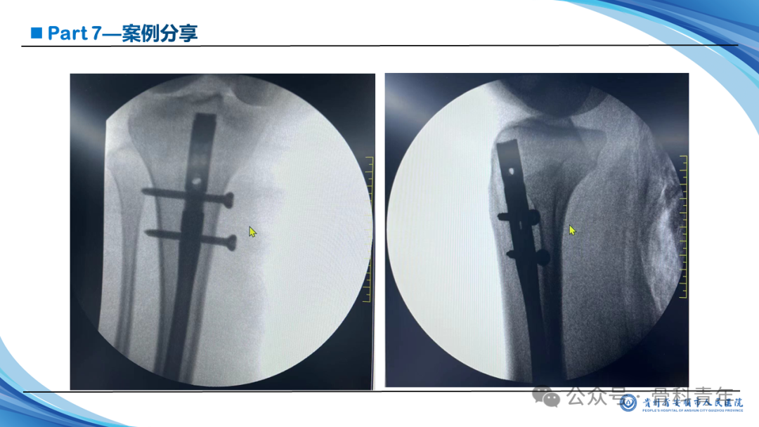 张-侯氏（Z-H）骨折的损伤机制、诊断与治疗