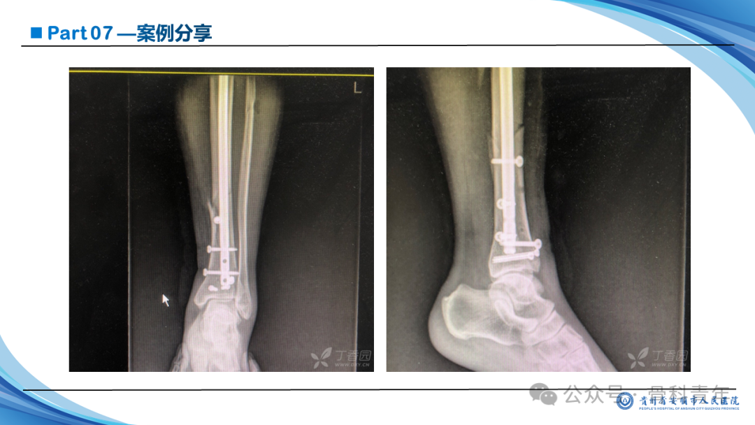 张-侯氏（Z-H）骨折的损伤机制、诊断与治疗