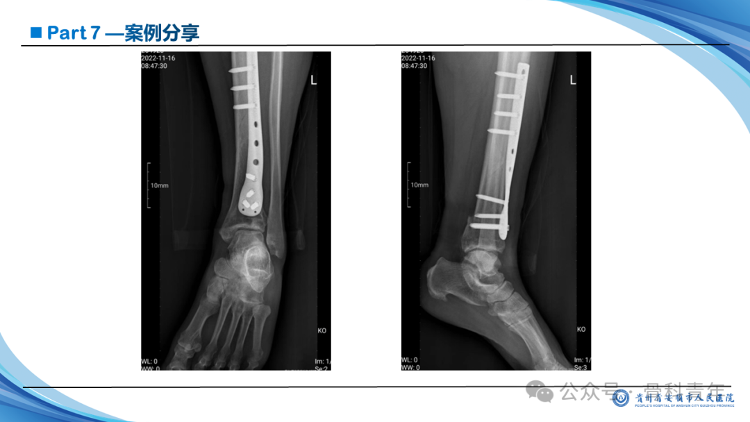 张-侯氏（Z-H）骨折的损伤机制、诊断与治疗