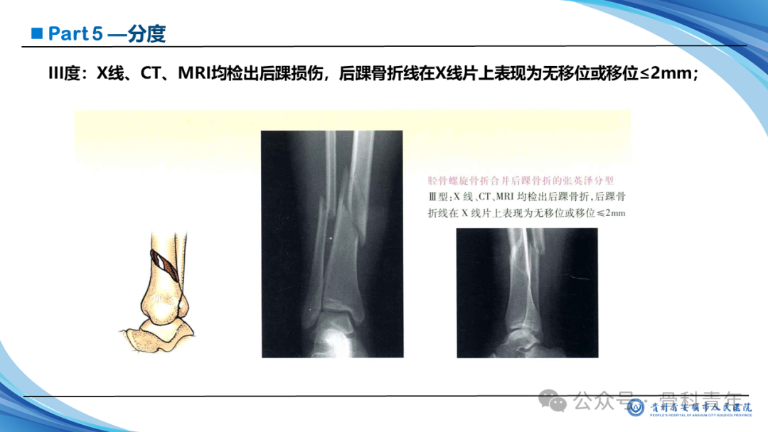 张-侯氏（Z-H）骨折的损伤机制、诊断与治疗