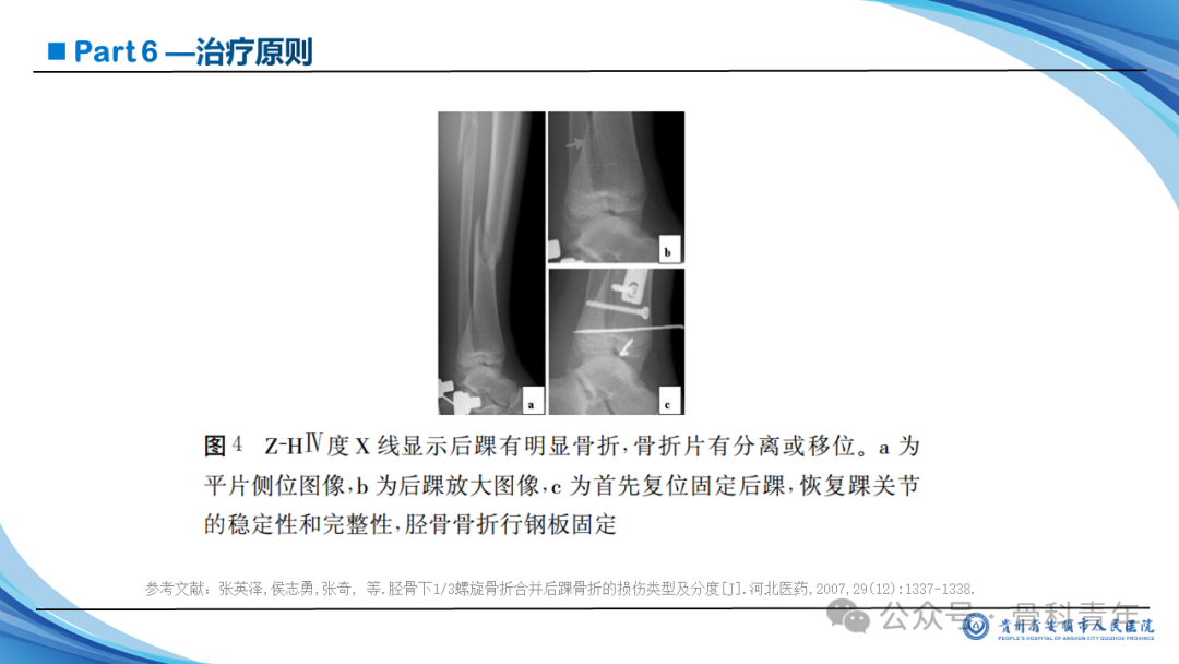 张-侯氏（Z-H）骨折的损伤机制、诊断与治疗
