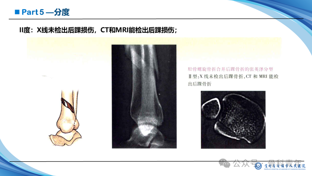 张-侯氏（Z-H）骨折的损伤机制、诊断与治疗