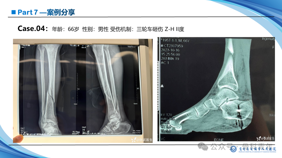 张-侯氏（Z-H）骨折的损伤机制、诊断与治疗