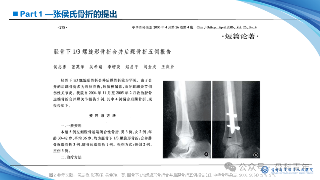 张-侯氏（Z-H）骨折的损伤机制、诊断与治疗