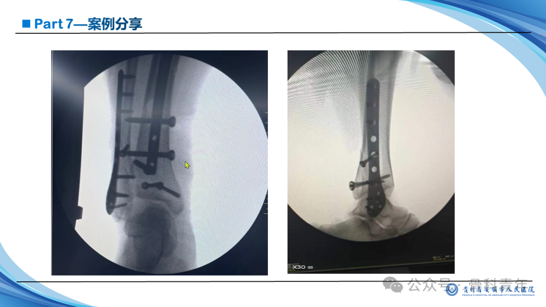 张-侯氏（Z-H）骨折的损伤机制、诊断与治疗