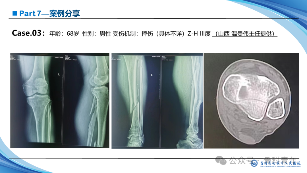 张-侯氏（Z-H）骨折的损伤机制、诊断与治疗