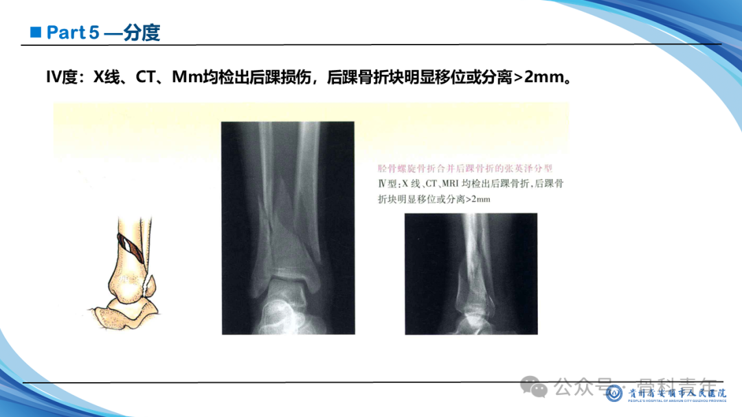 张-侯氏（Z-H）骨折的损伤机制、诊断与治疗