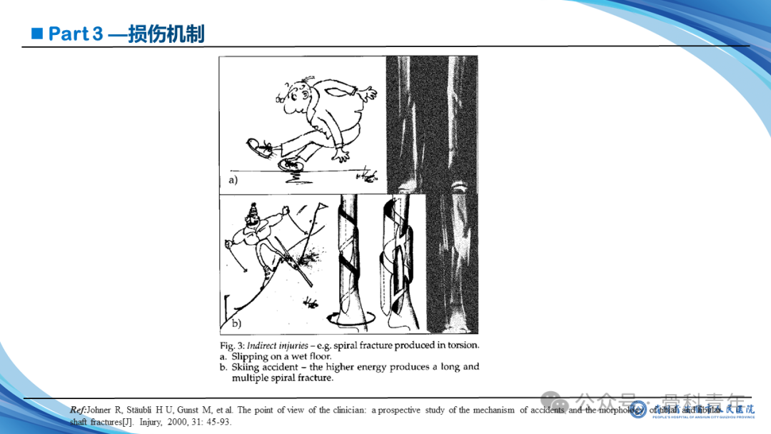 张-侯氏（Z-H）骨折的损伤机制、诊断与治疗