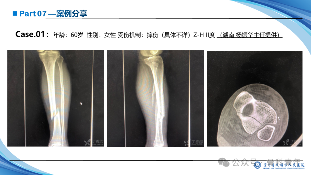 张-侯氏（Z-H）骨折的损伤机制、诊断与治疗
