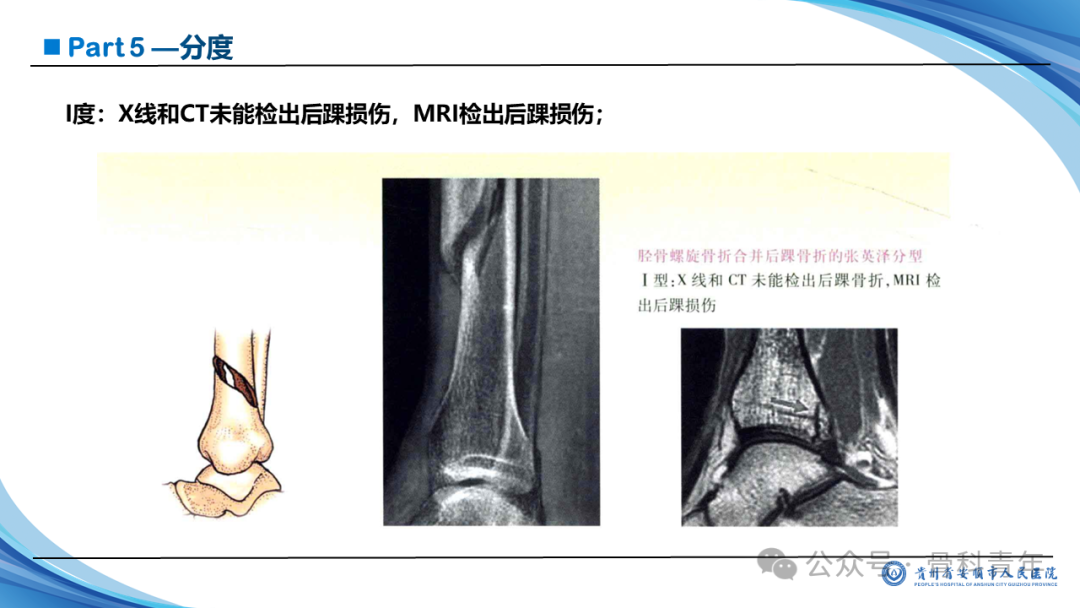 张-侯氏（Z-H）骨折的损伤机制、诊断与治疗