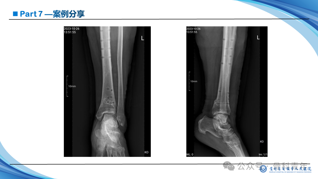 张-侯氏（Z-H）骨折的损伤机制、诊断与治疗