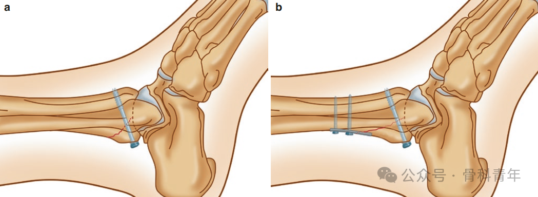 如何安全、有效地经皮置入后踝螺钉？