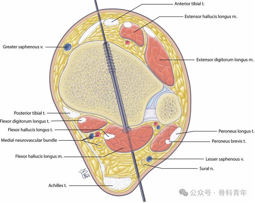 如何安全、有效地经皮置入后踝螺钉？