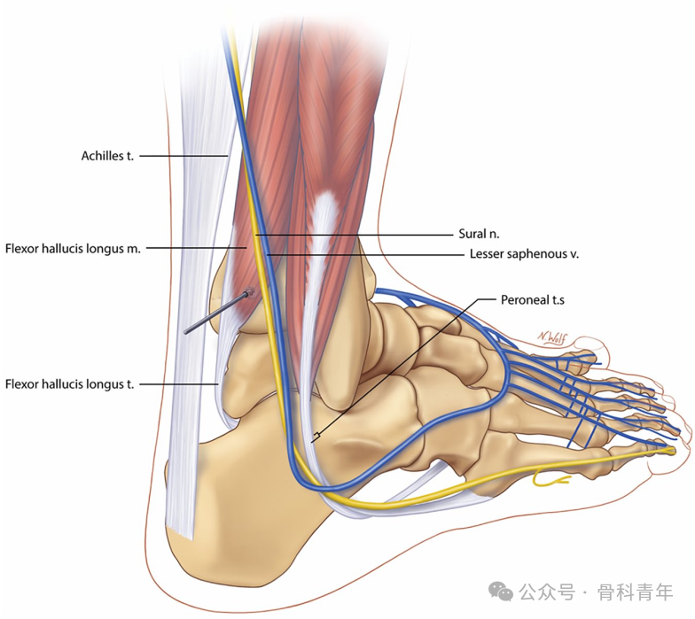 如何安全、有效地经皮置入后踝螺钉？