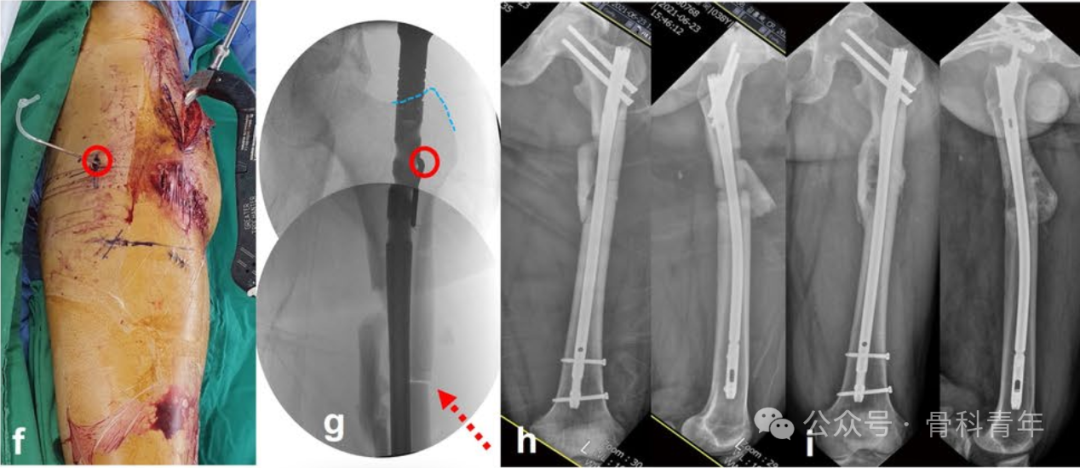 粗隆下骨折，如何巧妙使用“阻挡钉”？