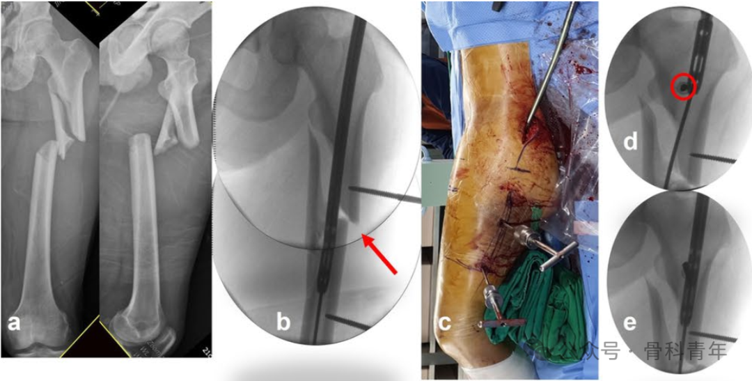 粗隆下骨折，如何巧妙使用“阻挡钉”？
