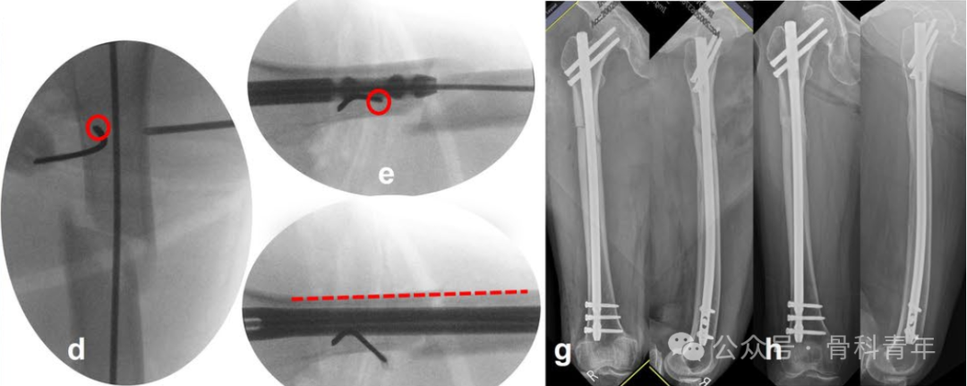 粗隆下骨折，如何巧妙使用“阻挡钉”？