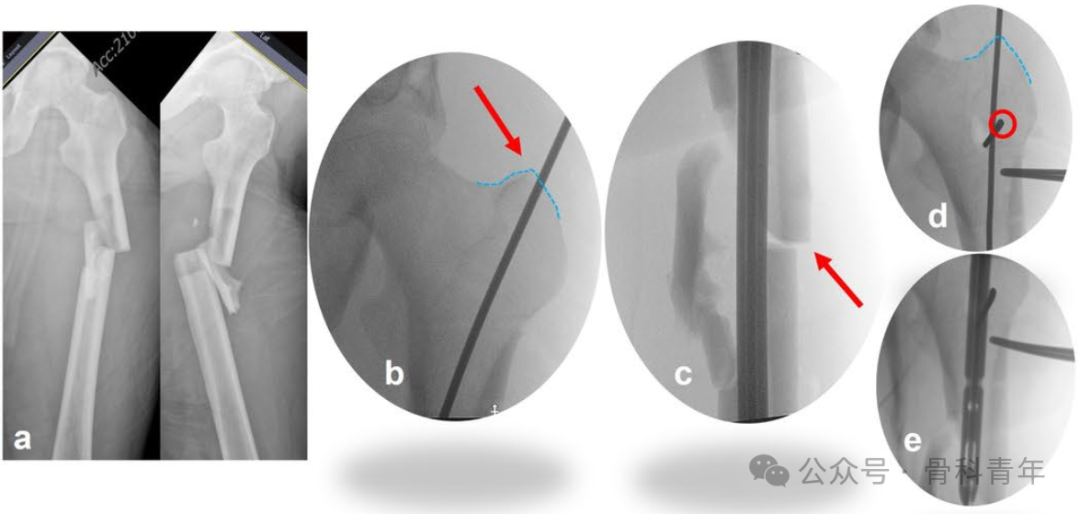 粗隆下骨折，如何巧妙使用“阻挡钉”？