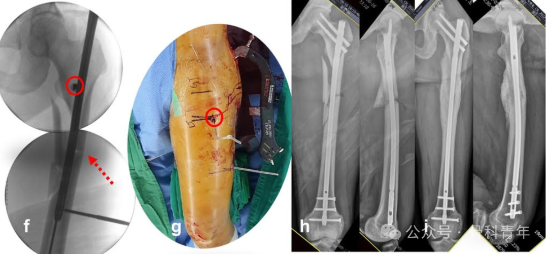 粗隆下骨折，如何巧妙使用“阻挡钉”？