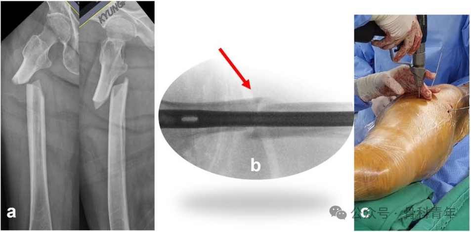 粗隆下骨折，如何巧妙使用“阻挡钉”？
