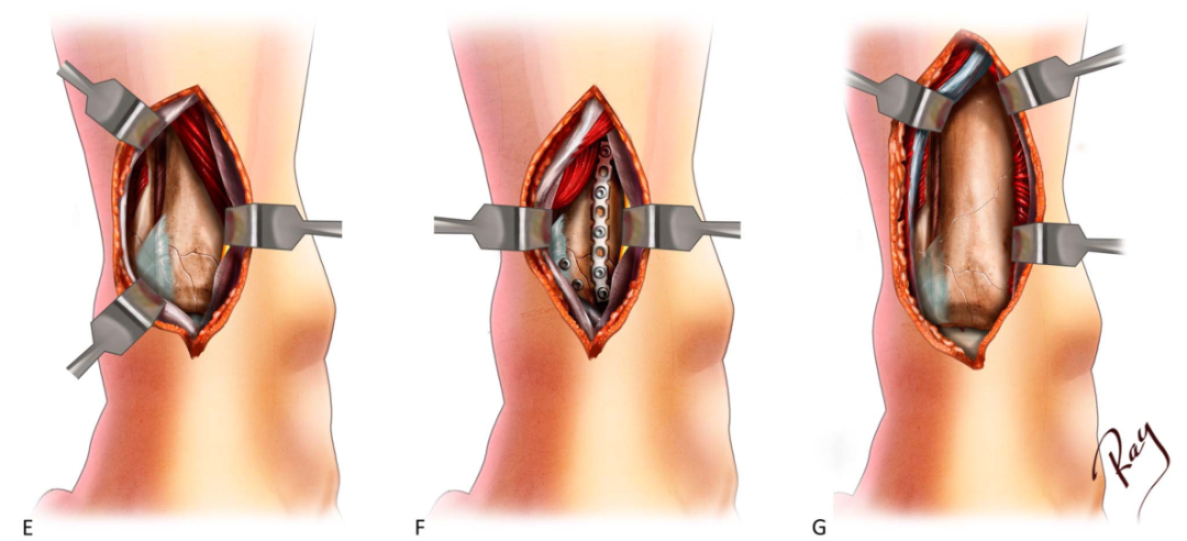 Pilon骨折手术入路环：7种手术入路解析