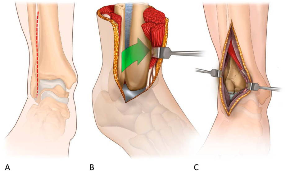 Pilon骨折手术入路环：7种手术入路解析