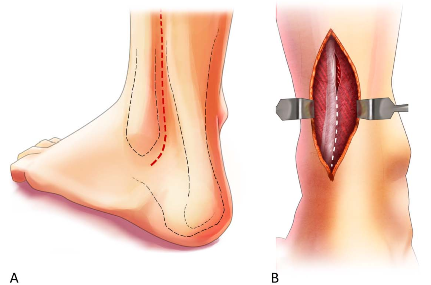 Pilon骨折手术入路环：7种手术入路解析