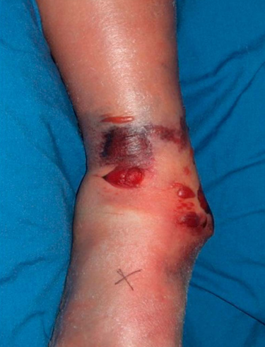 Pilon骨折手术入路环：7种手术入路解析