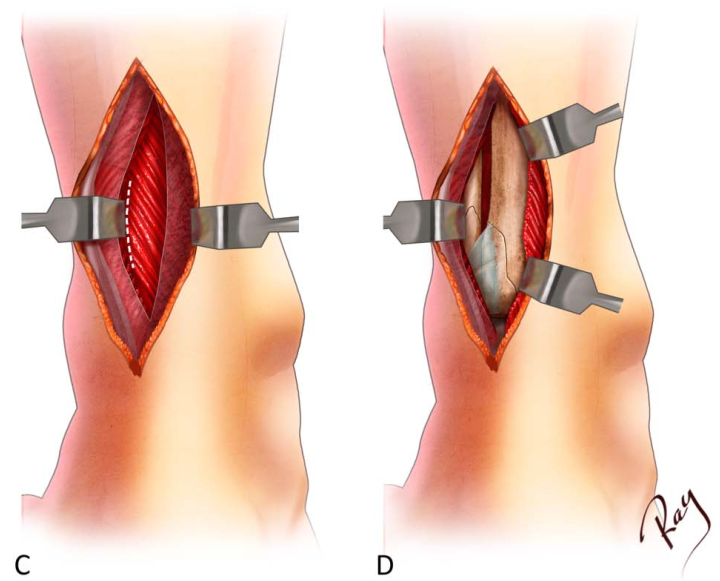 Pilon骨折手术入路环：7种手术入路解析