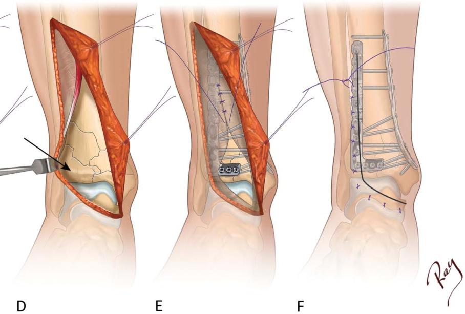 Pilon骨折手术入路环：7种手术入路解析