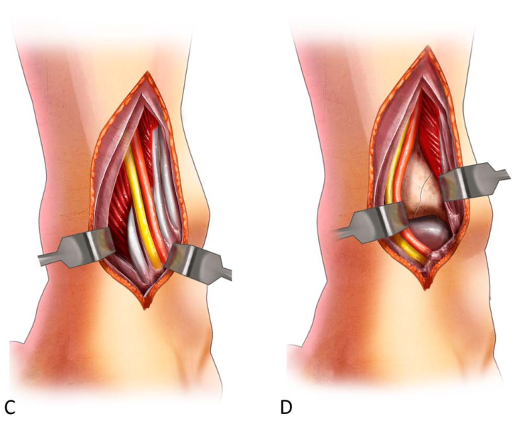 Pilon骨折手术入路环：7种手术入路解析