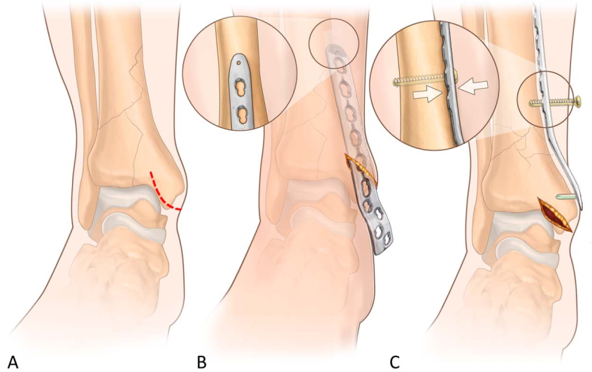 Pilon骨折手术入路环：7种手术入路解析