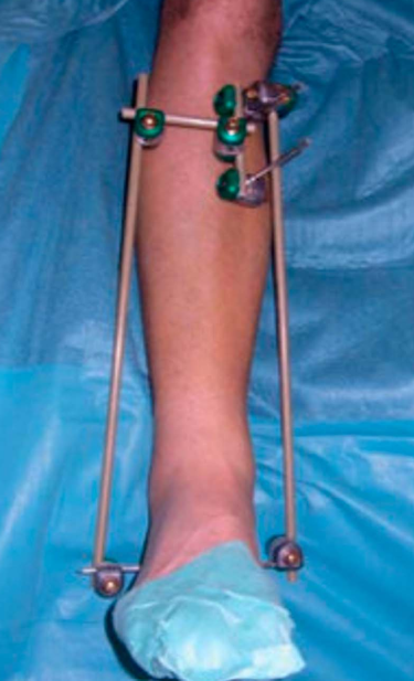 Pilon骨折手术入路环：7种手术入路解析