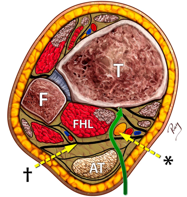 Pilon骨折手术入路环：7种手术入路解析