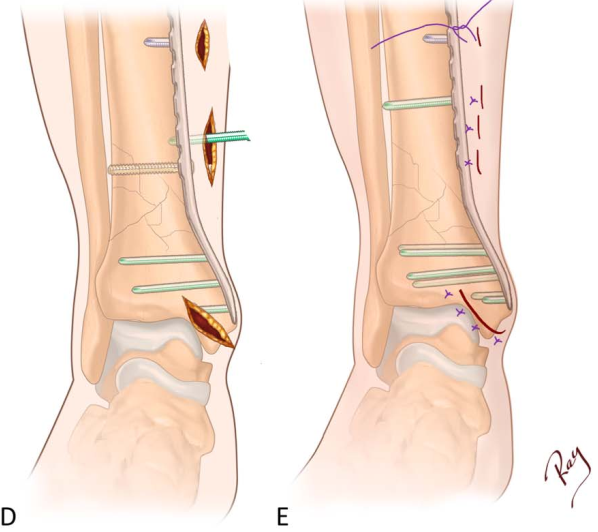 Pilon骨折手术入路环：7种手术入路解析