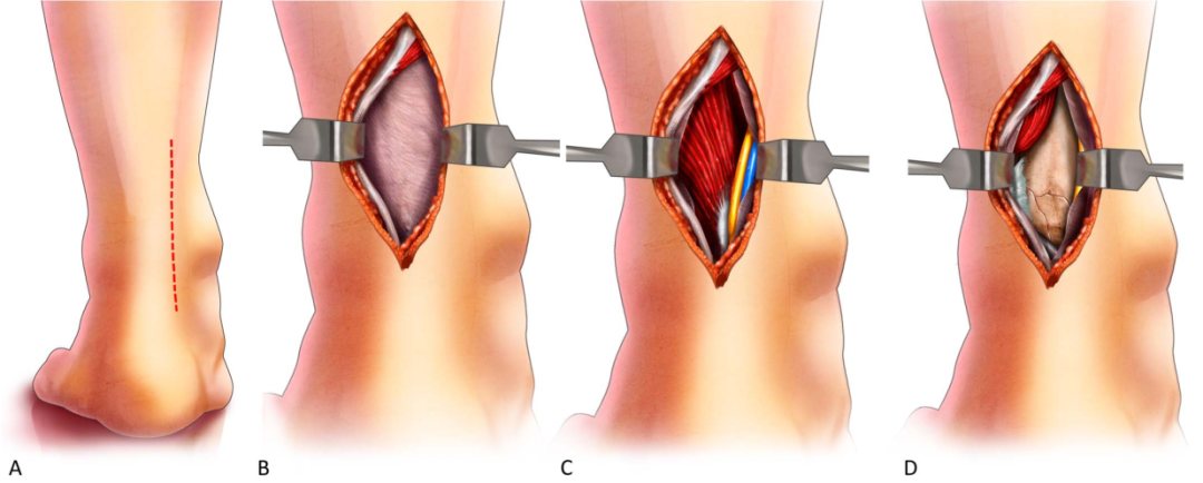 Pilon骨折手术入路环：7种手术入路解析