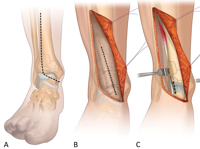 Pilon骨折手术入路环：7种手术入路解析