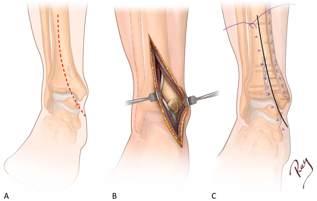 Pilon骨折手术入路环：7种手术入路解析