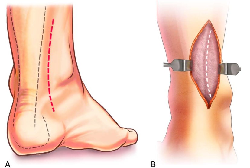 Pilon骨折手术入路环：7种手术入路解析