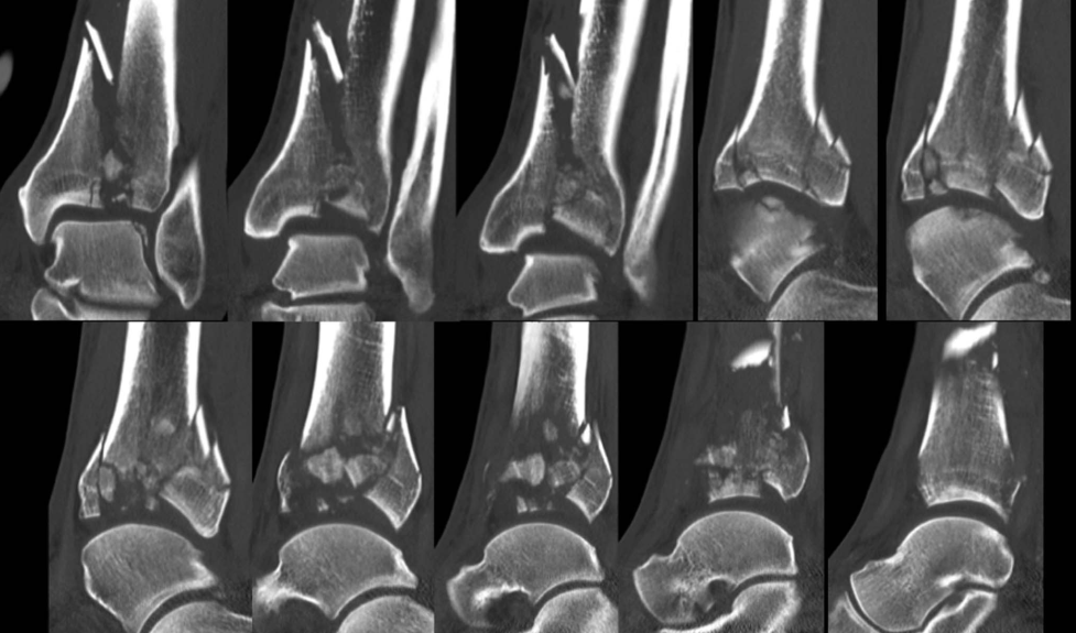 Pilon骨折手术入路环：7种手术入路解析