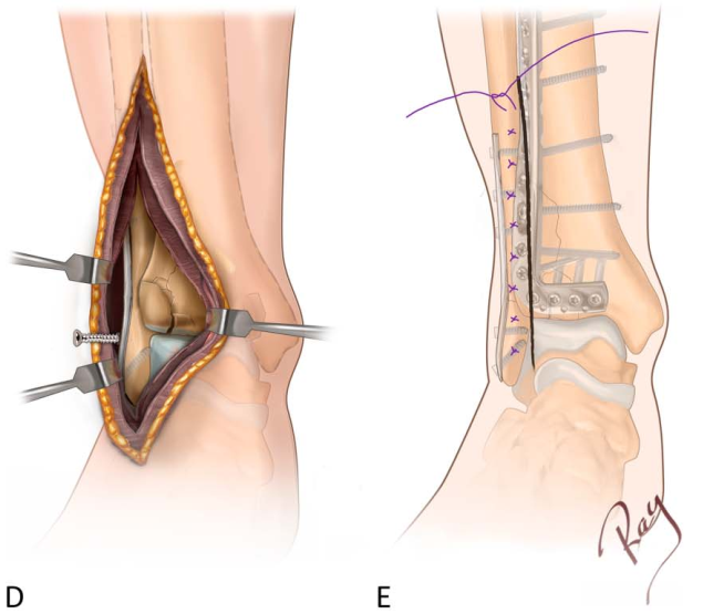 Pilon骨折手术入路环：7种手术入路解析