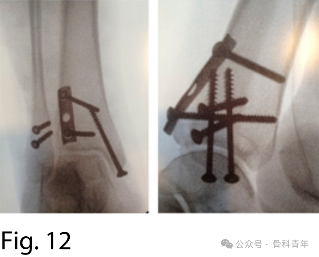 手术“金标准”：后外侧入路固定后踝骨折的手术步骤详解（JBJS经验）